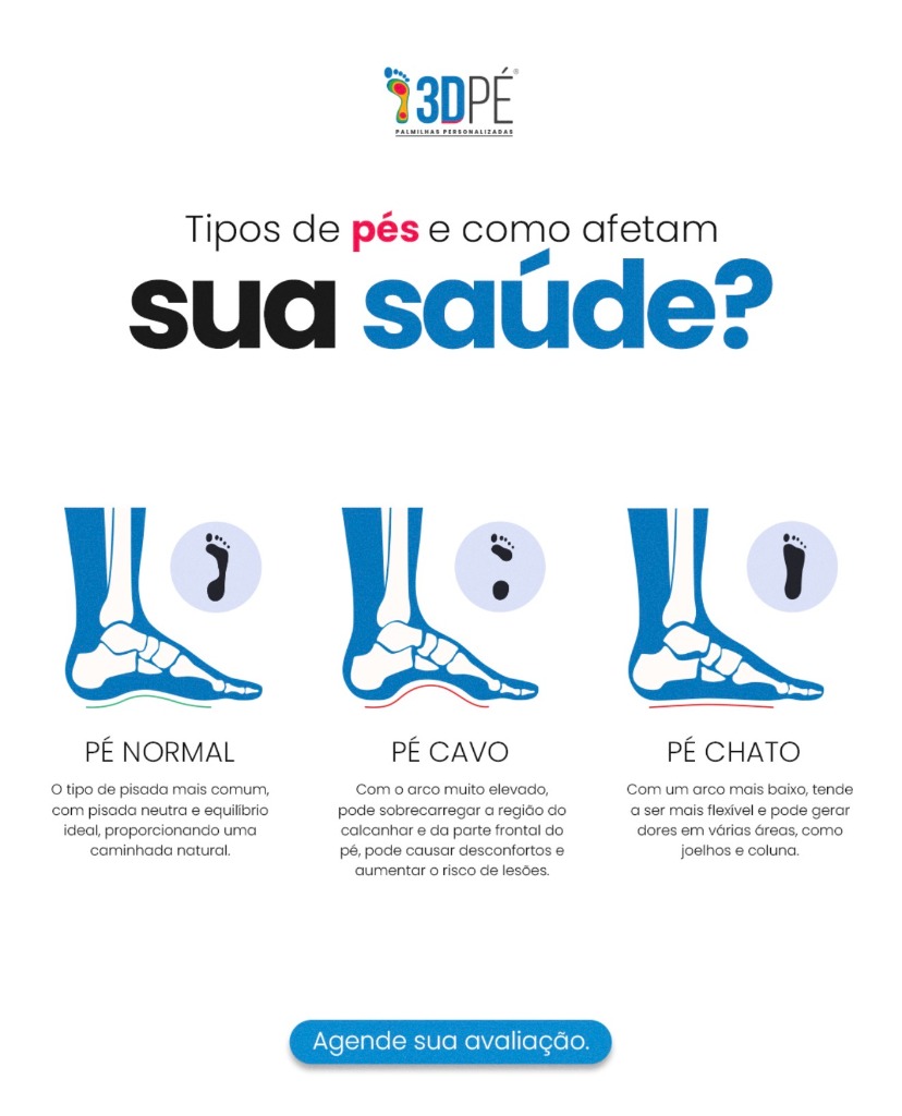 Tipos de pisada e como afetam a saúde